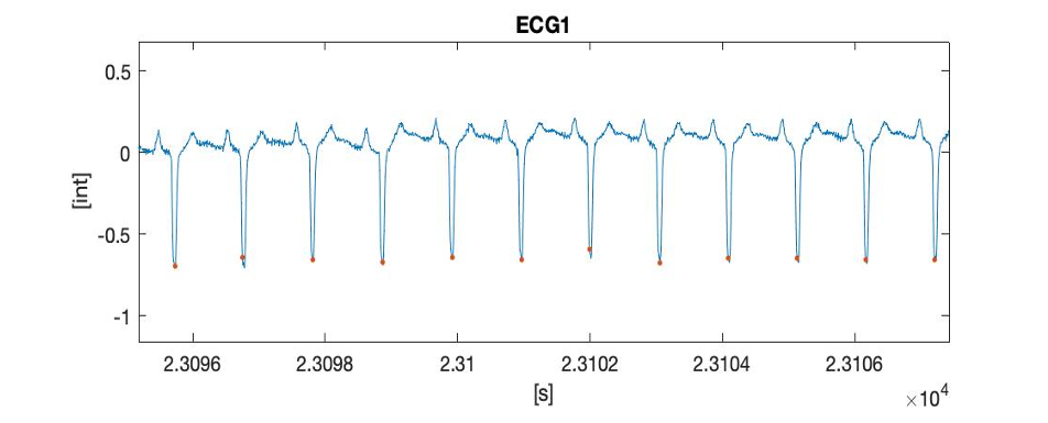 ECG